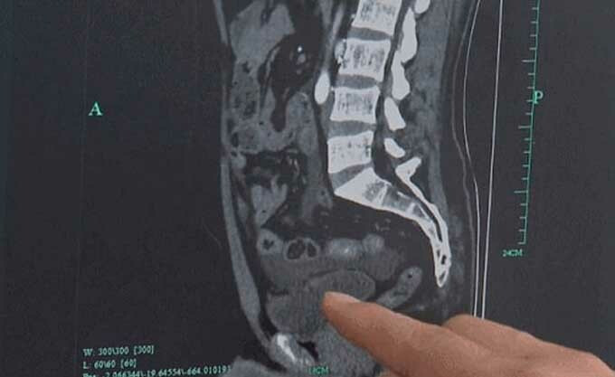 3 lỗ xuất hiện ở bàng quang của người đàn ông sau khi uống quá nhiều bia mà không đi tiểu.